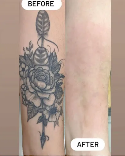 Bonsai Laser Tattoo Removal