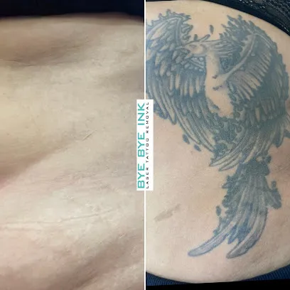 Bye Bye Ink Laser Tattoo Removal