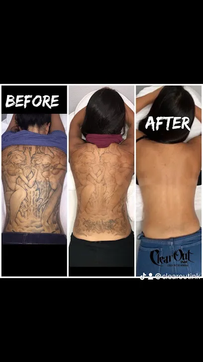 Clear Out Ink Laser Tattoo Removal