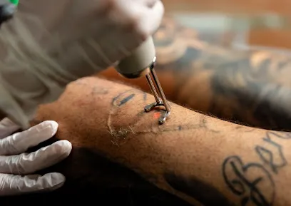 Legendary Laser Tattoo Removal