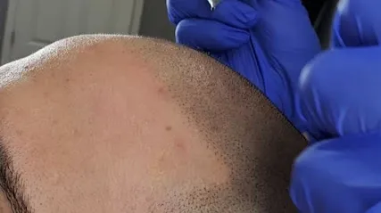 Micro Capillary Solution