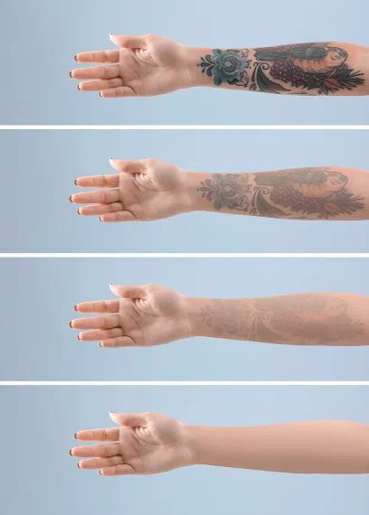 Tattoo Removal Project