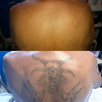 Winter Park Tattoo Removal